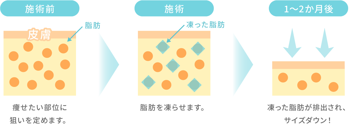 脂肪冷却のメカニズムの図